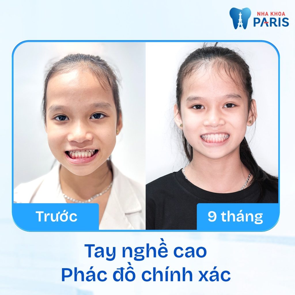 Nha Khoa Paris - Nâng Tầm Nụ Cười, Khẳng Định Phong Cách Sống 10 Kết quả điều trị tích cực tại Paris