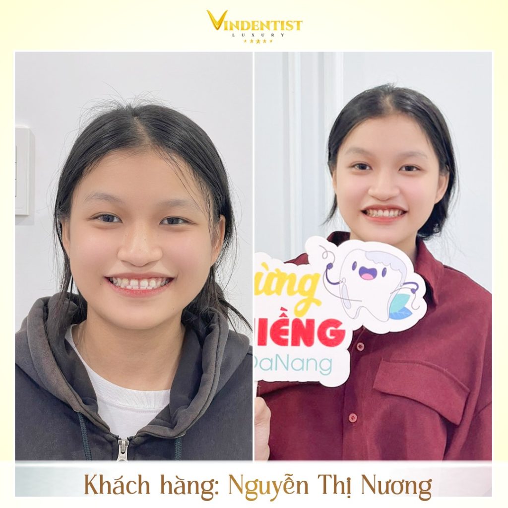 Kết quả điều trị tích cực tại VIN Dentist